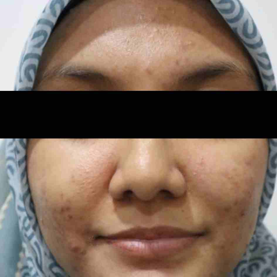 Before Pico Laser
