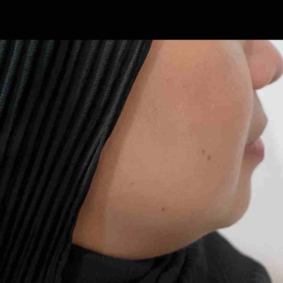 Before Pico Laser