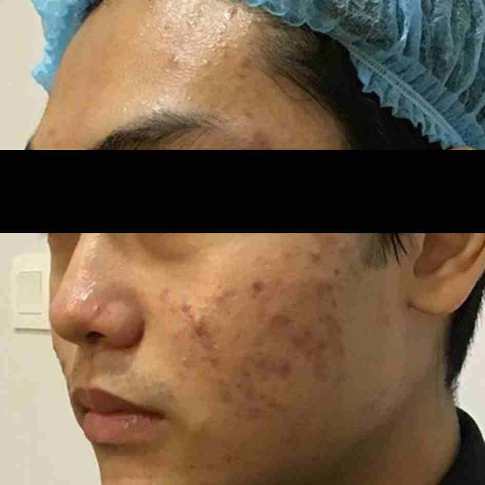 Before Pico Laser