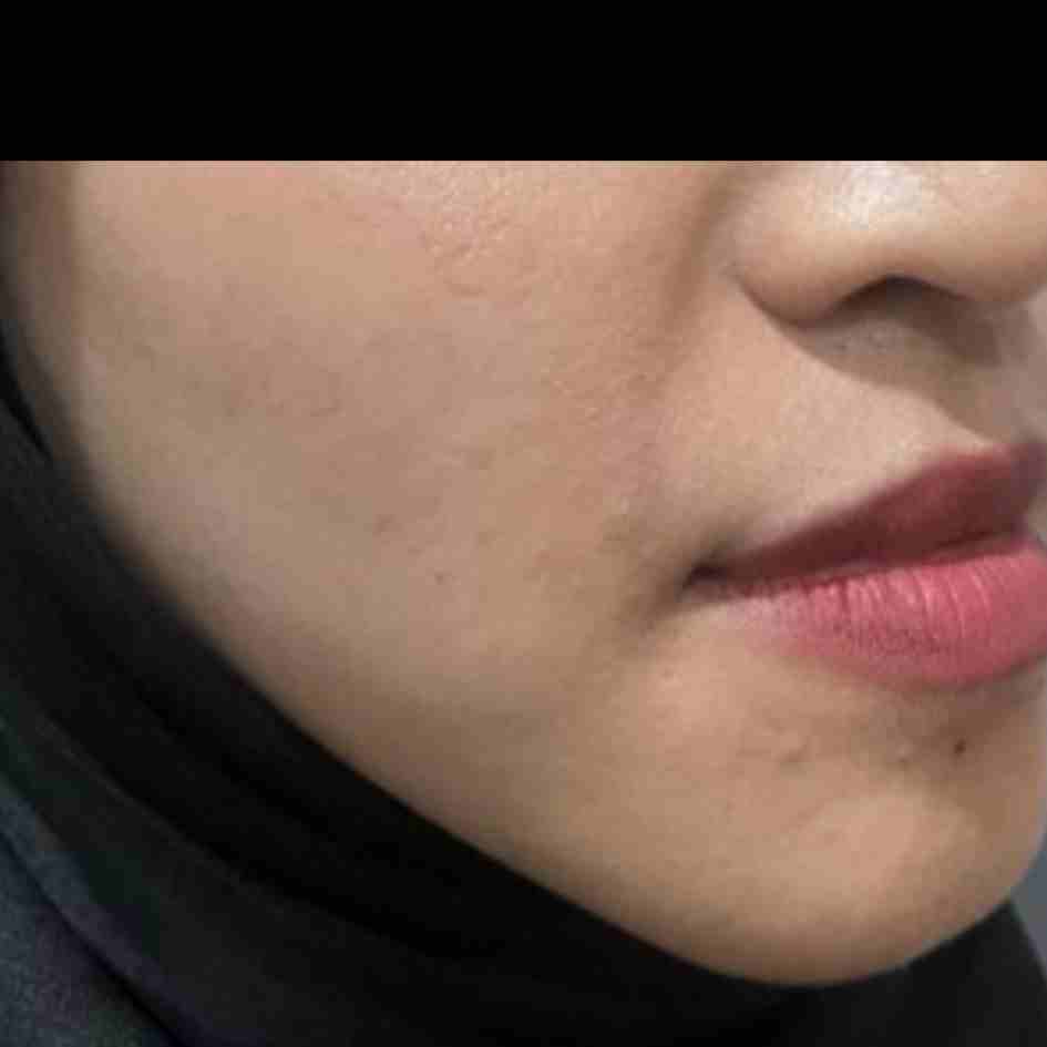 Before Pico Laser