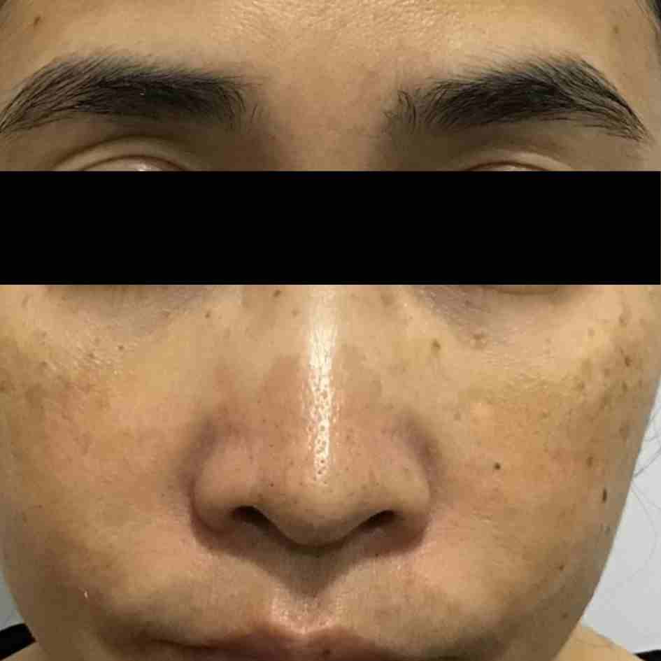 Before Pico Laser