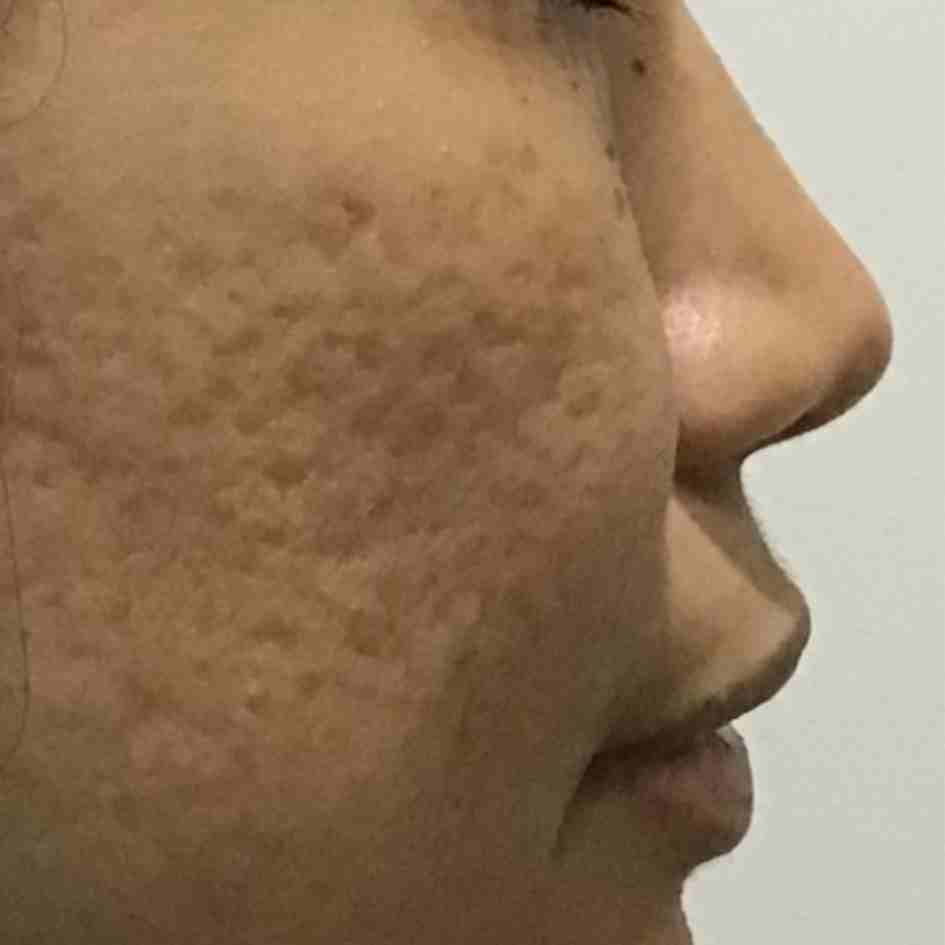 Before Pico Laser