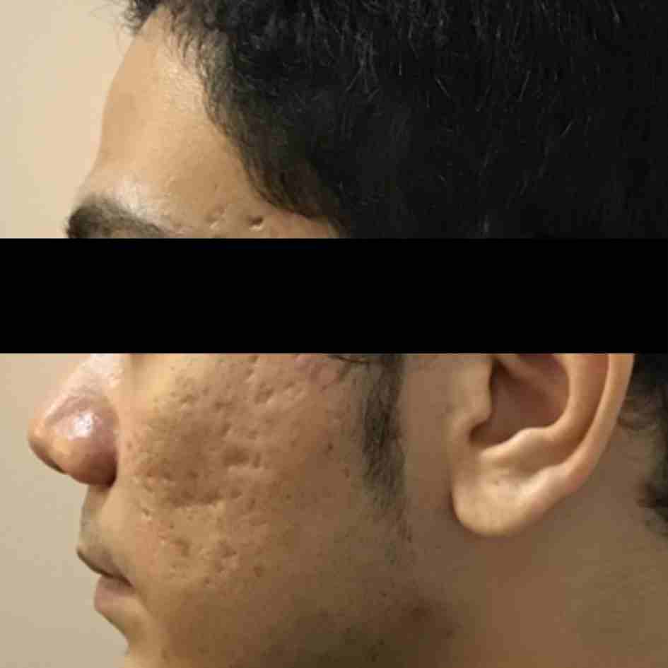 Before Pico Laser