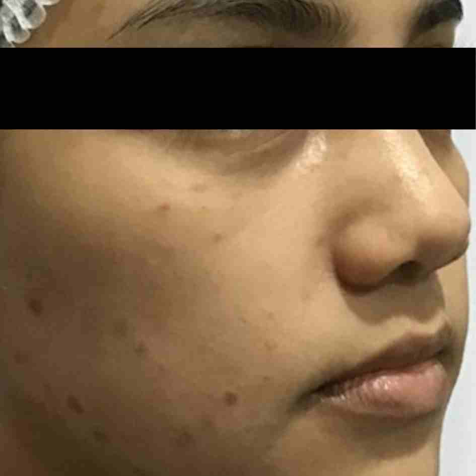 Before Pico Laser