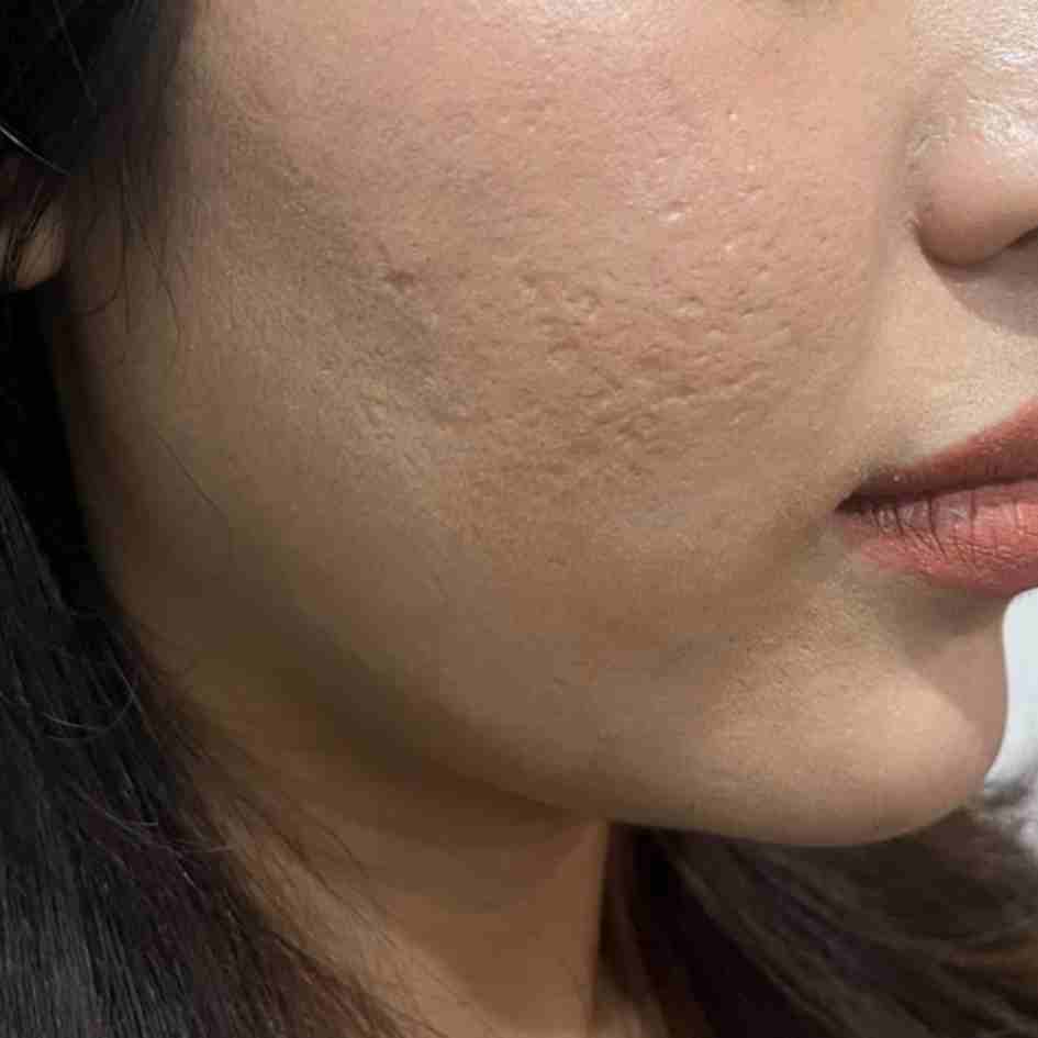 Before Pico Laser