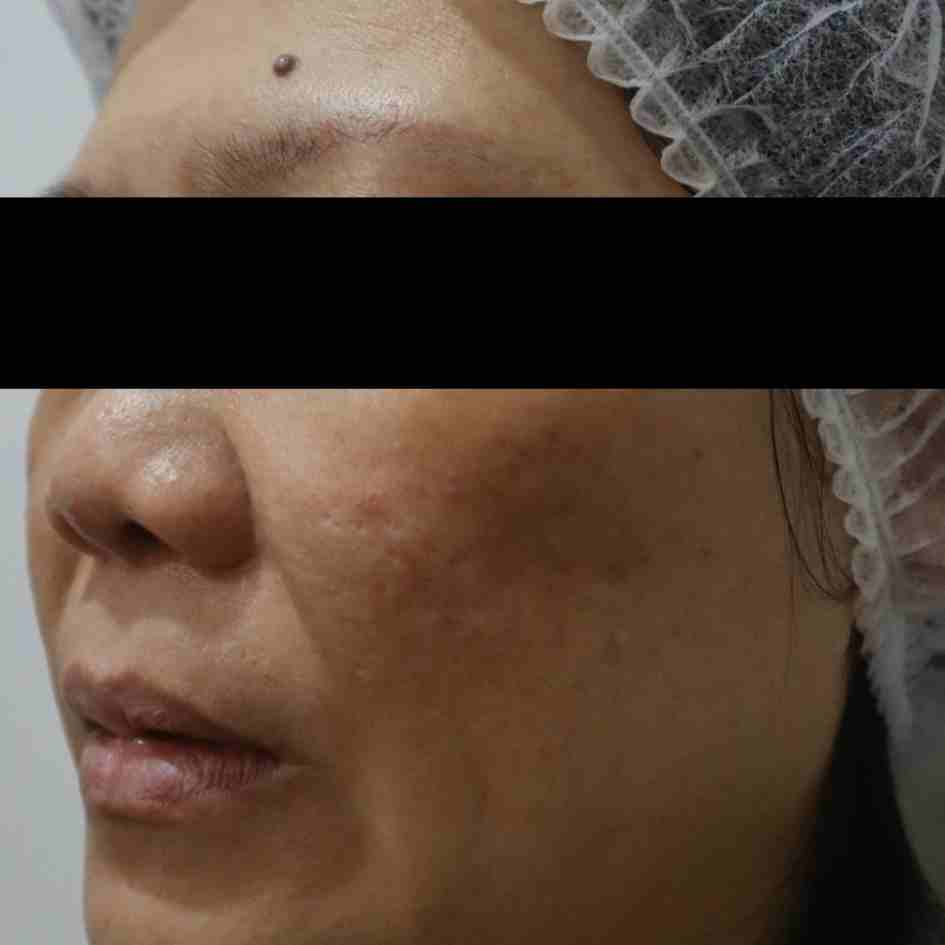 Before Pico Laser