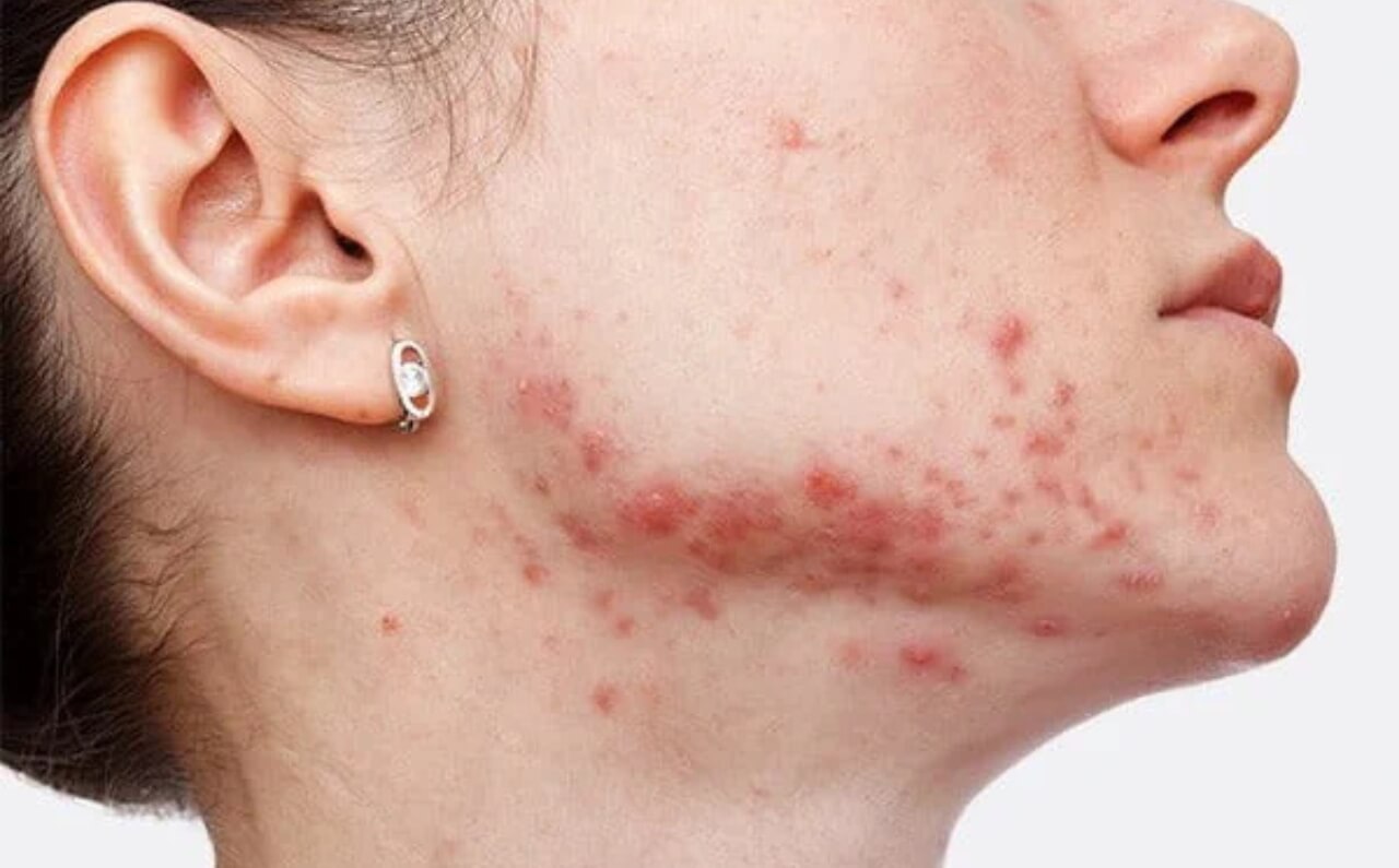 A woman with her jaw covered in severe Post Inflammatory Hyperpigmentation (PIH).
