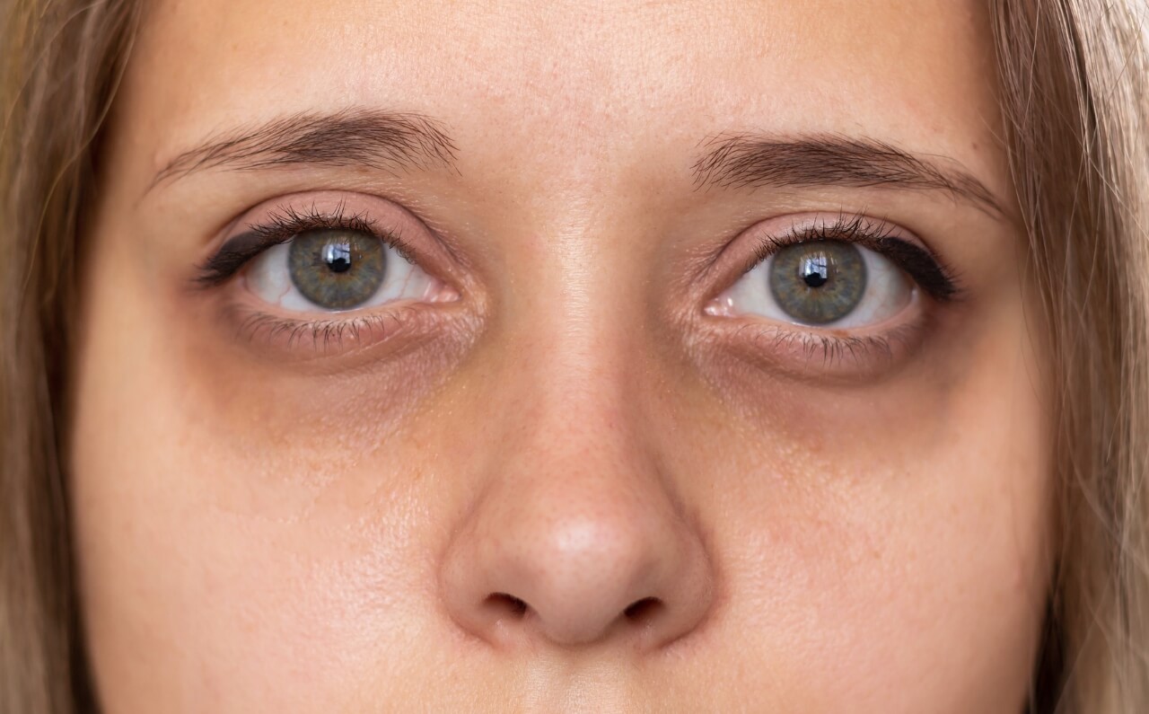 A woman with severe dark circles around her eyes.