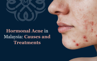 Hormonal Acne in Malaysia: Causes and Treatments