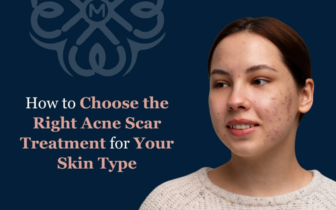 How to Choose the Right Acne Scar Treatment for Your Skin Type