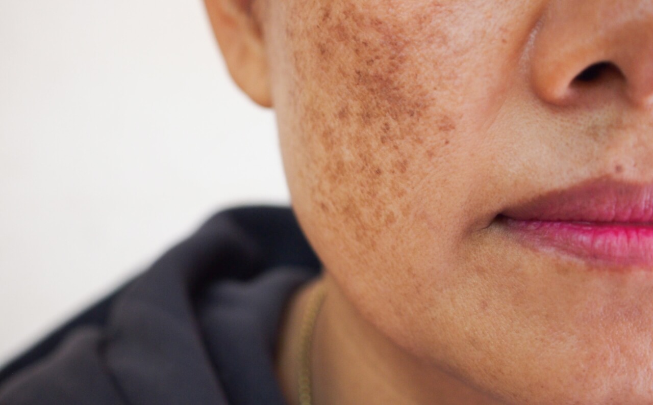A woman with noticable brown spots appearing on her cheeks.