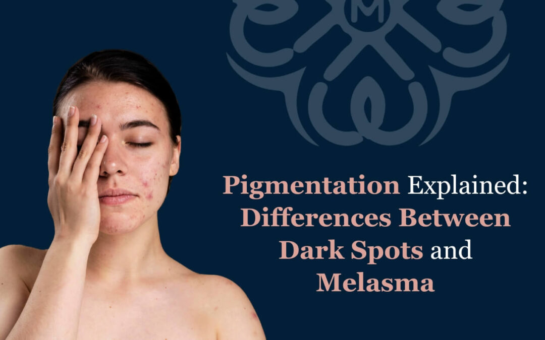 Pigmentation Explained: Differences Between Dark Spots and Melasma