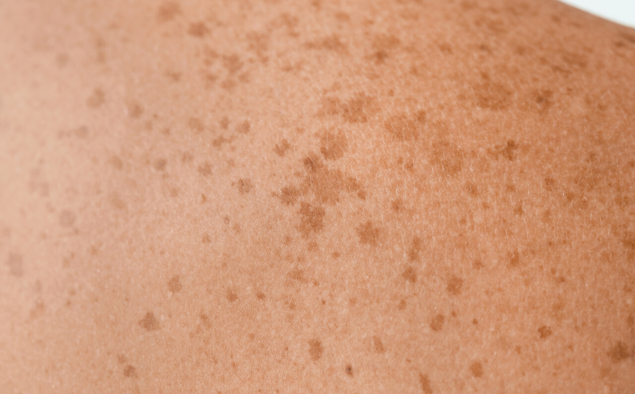 Sunspots appearing on the surface of the skin.