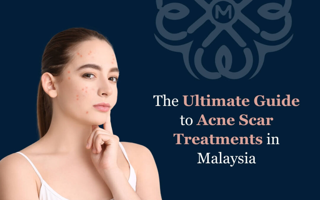 The Ultimate Guide to Acne Scar Treatments in Malaysia