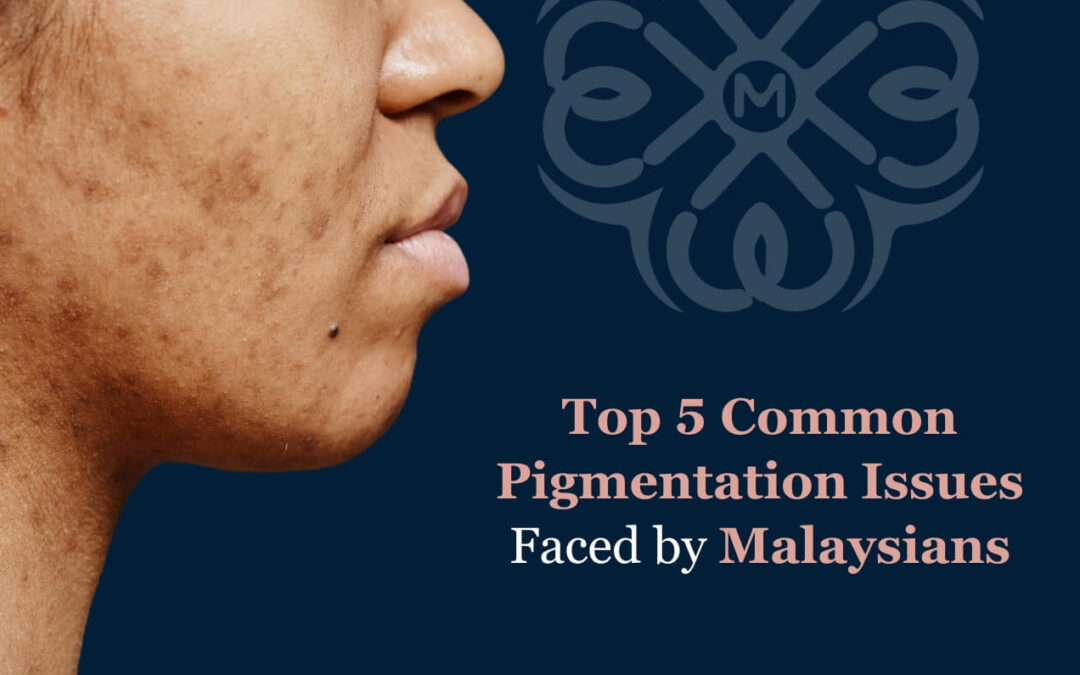 Top 5 Common Pigmentation Issues Faced by Malaysians