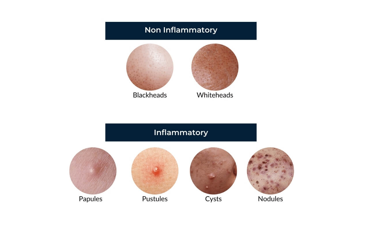 A diagram to showcase different types of acne.