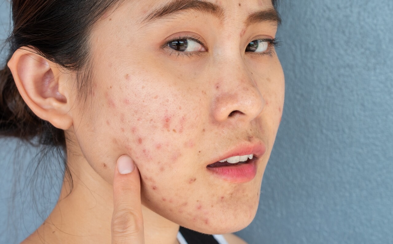 A woman looking distressed, touching the side of her face covered in hormonal acne.