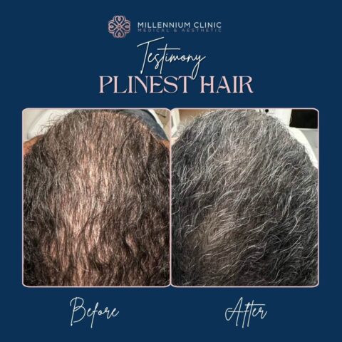 PLINEST Hair - Millennium Clinic KL