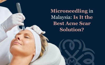 Microneedling in Malaysia: Is It the Best Acne Scar Solution?