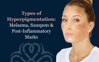 Types of Hyperpigmentation: Melasma, Sunspots & Post-Inflammatory Marks