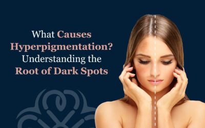 What Causes Hyperpigmentation? Understanding the Root of Dark Spots