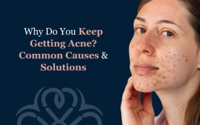 Why Do You Keep Getting Acne? Common Causes & Solutions
