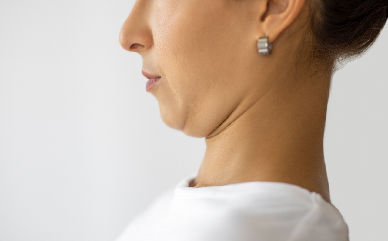Woman with visible double chin, illustrating common areas treated with fat dissolving injections.