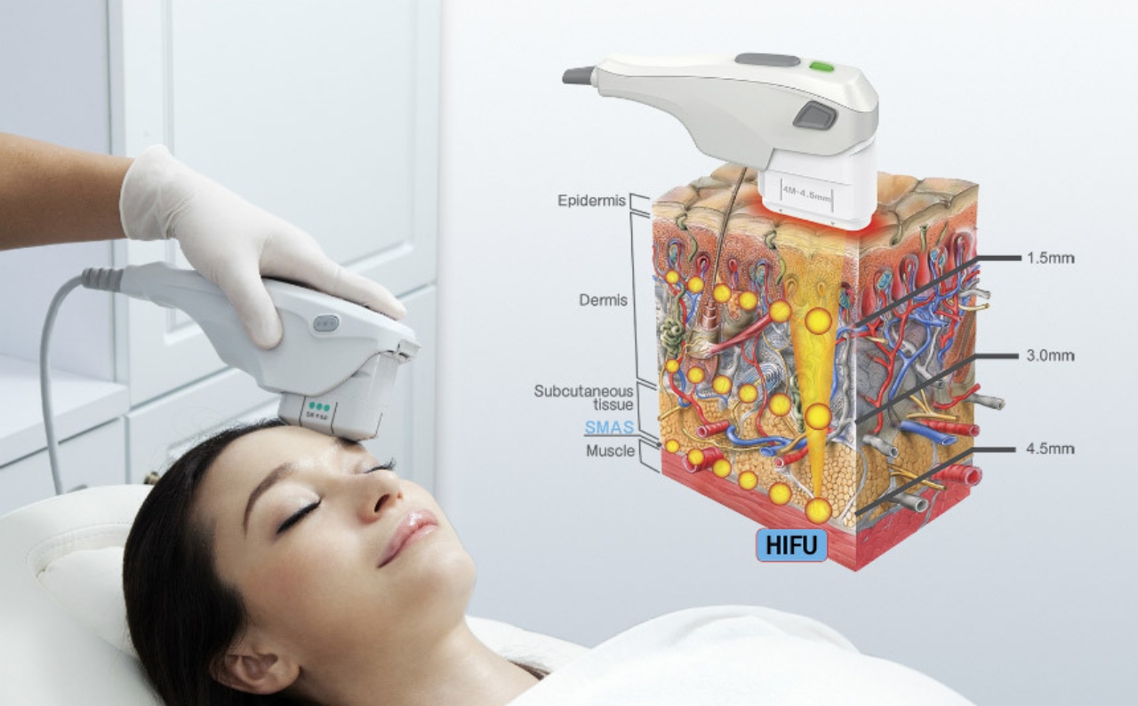 HIFU device being applied to a woman’s face during non-invasive skin lifting treatment.