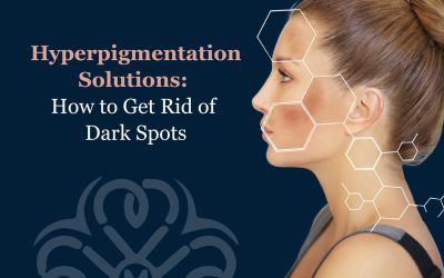 Hyperpigmentation Solutions: How to Get Rid of Dark Spots