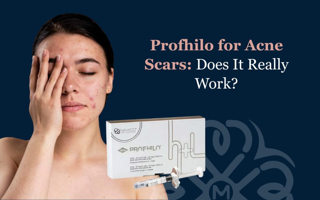 Profhilo for Acne Scars: Does It Really Work?