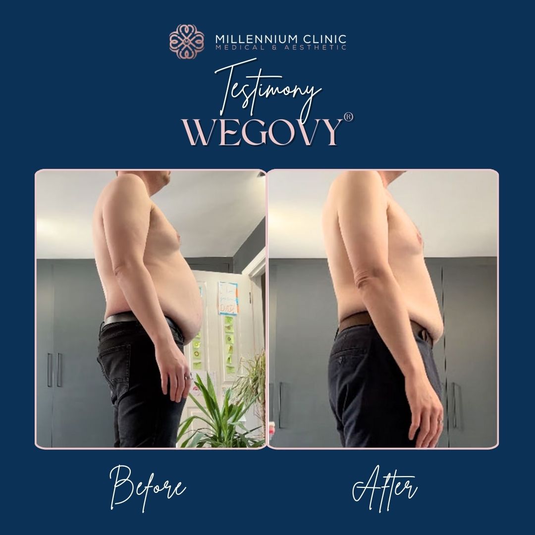 Wegovy® before after 2
