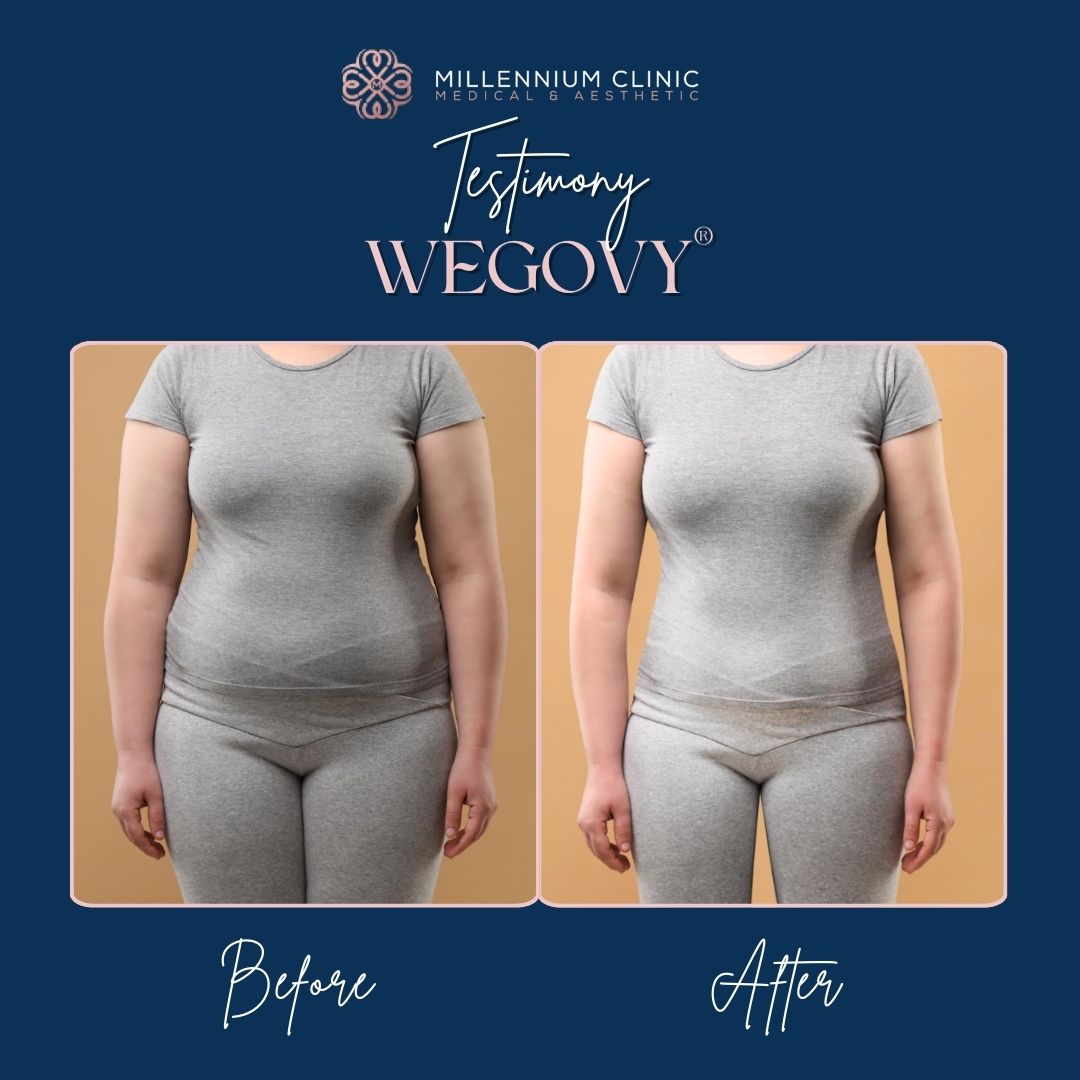 Wegovy® before after 3