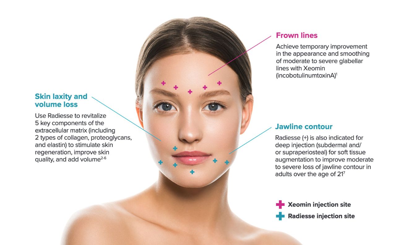 A diagram of a woman highlighting common Radiesse treatment areas such as cheeks, jawline, and hands, showing how Radiesse works beneath the skin to restore volume and firmness.