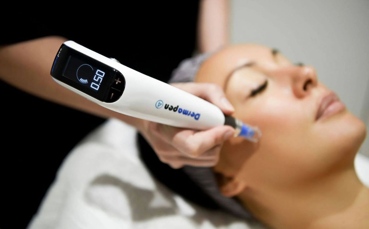 Doctor performing Dermapen 4 microneedling treatment on a patient’s face to reduce acne scars and improve skin texture at Millennium Clinic KL.