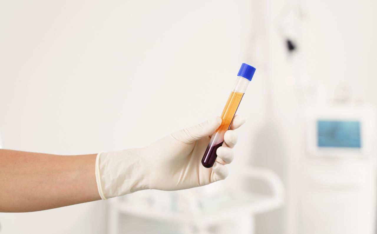 Dermatologist holding a vial of Platelet Rich Plasma (PRP), illustrating PRP treatment at Millennium Clinic KL for skin rejuvenation, anti-ageing, and natural healing.