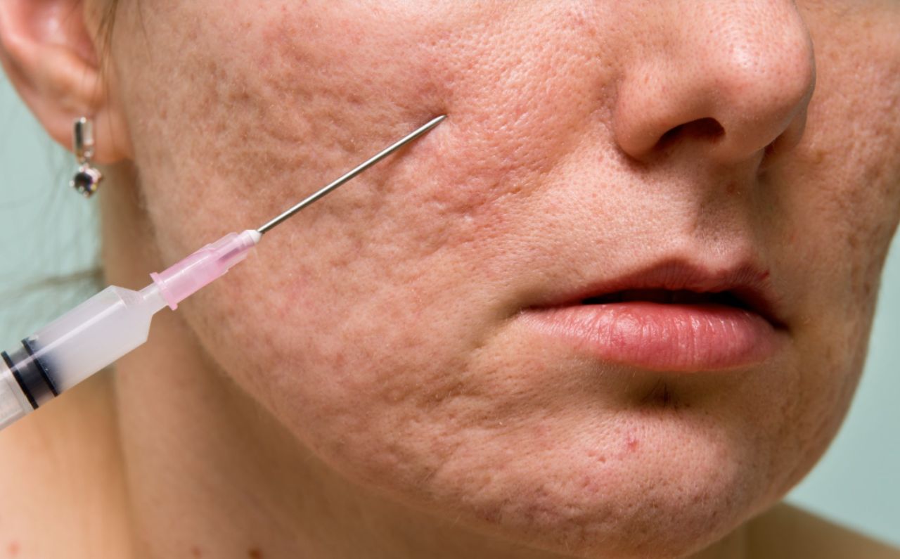 Woman with pitted acne scars undergoing Subcision treatment at Millennium Clinic KL, a professional procedure that helps release fibrotic scar tissue and improve skin texture.