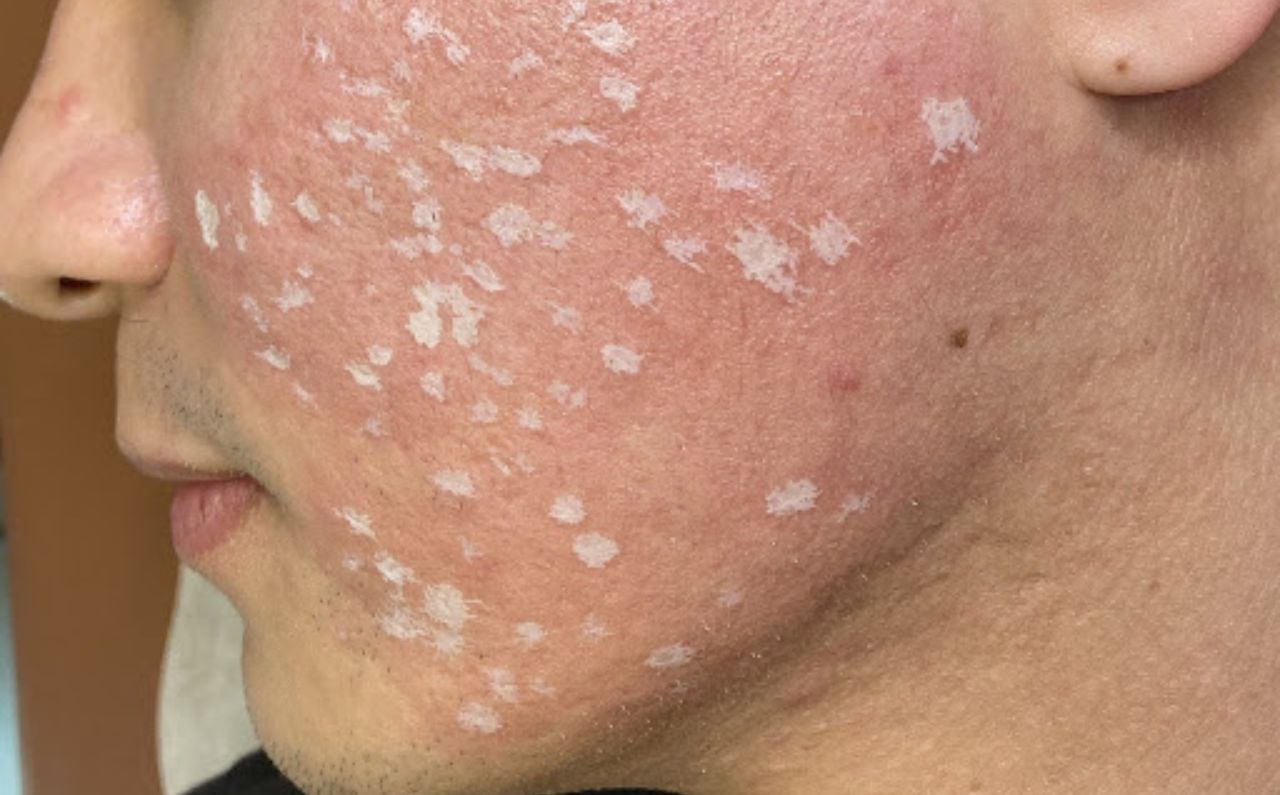 Close-up of a patient’s face undergoing TCA Cross treatment at Millennium Clinic KL, showing precise application for acne scar improvement and skin texture restoration.