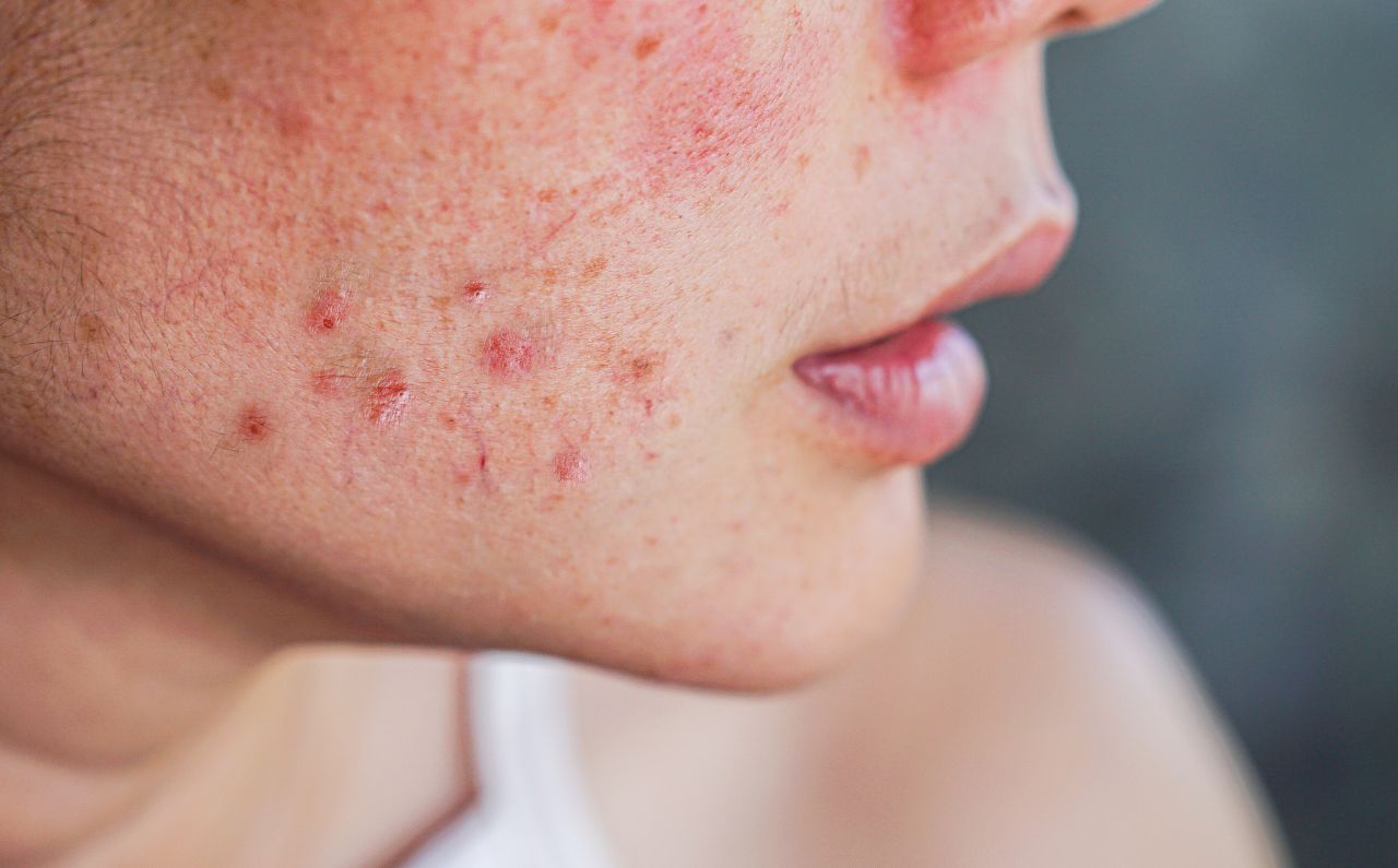 Close-up of a woman with inflamed acne and visible scars, illustrating common causes of acne scarring and skin concerns addressed at Millennium Clinic KL.