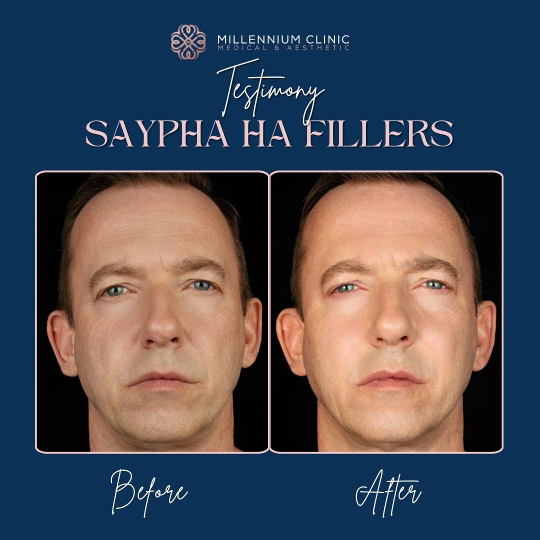 Saypha HA Fillers before after 1