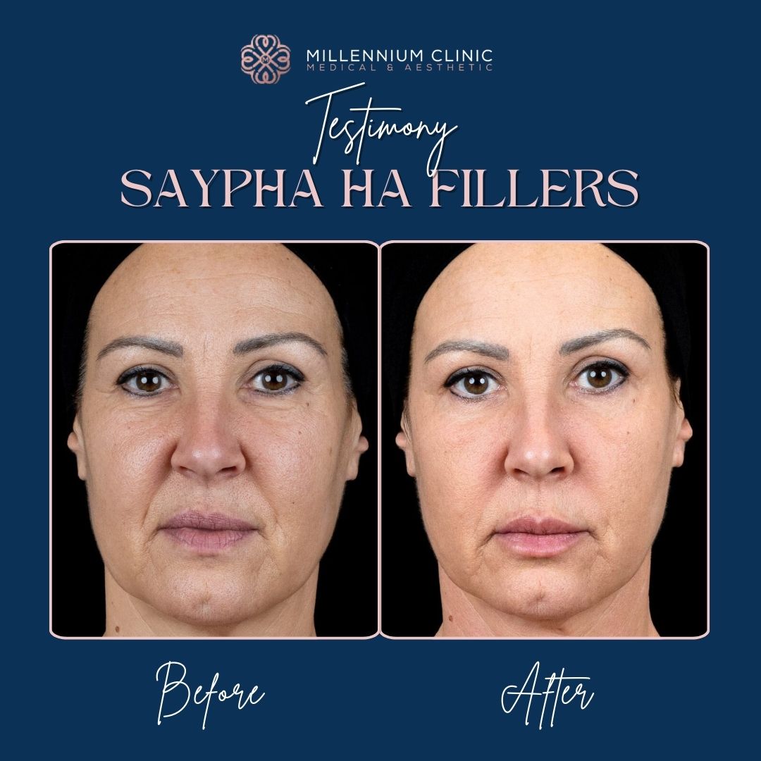 Saypha HA Fillers before after 2