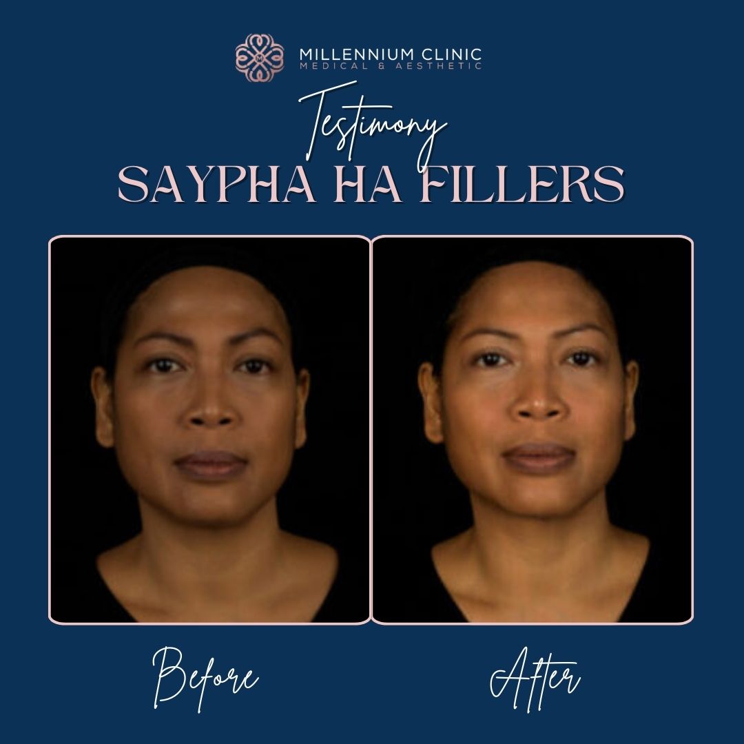 Saypha HA Fillers before after 3