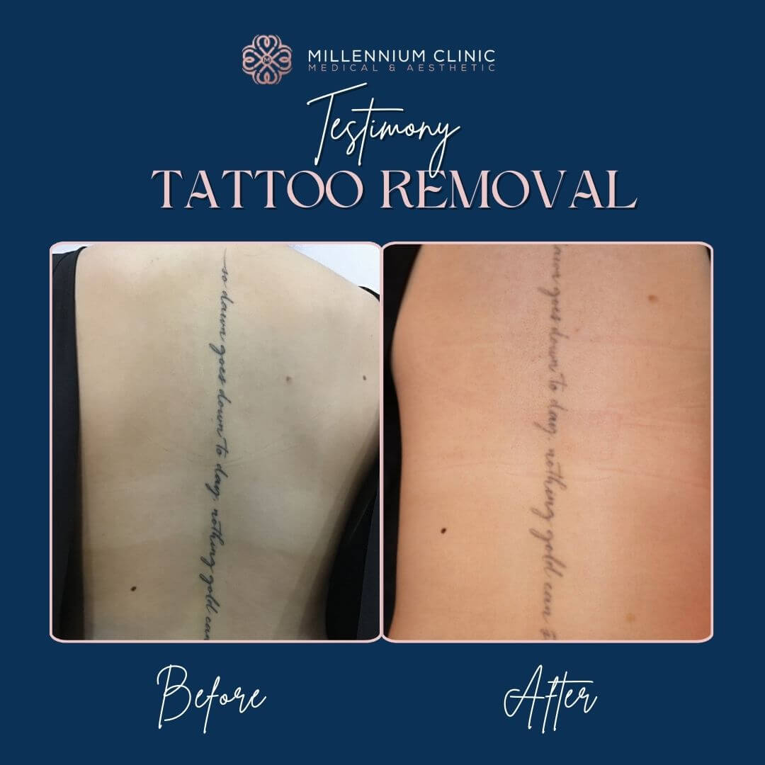 tattoo removal before after 1
