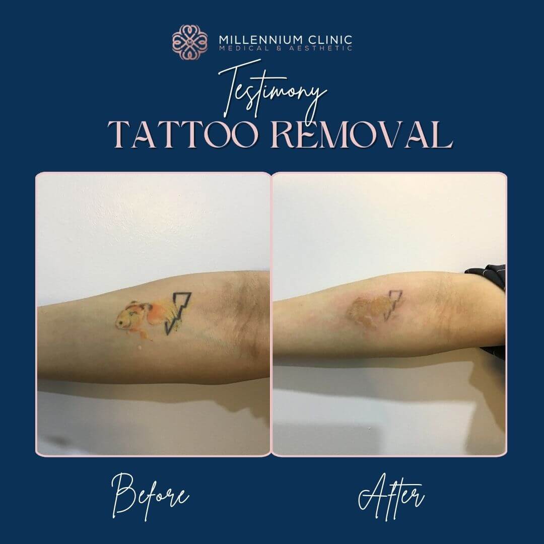 tattoo removal before after 2