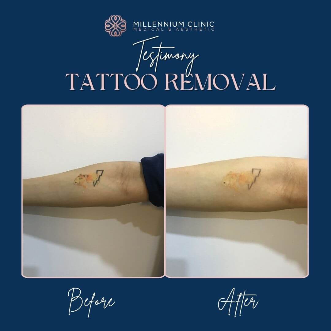 tattoo removal before after 3