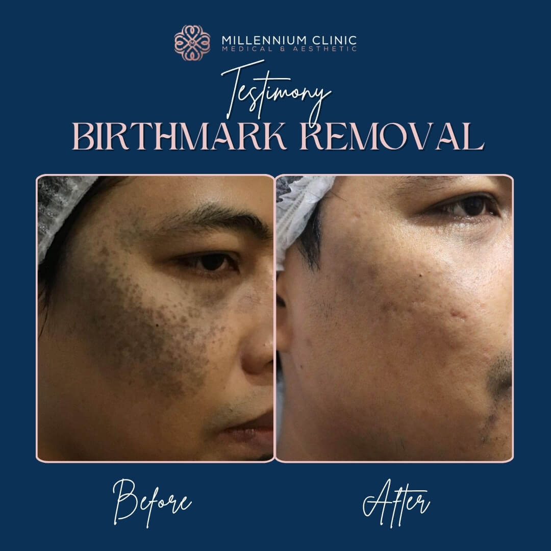 Birthmark_Removal__before_after_1