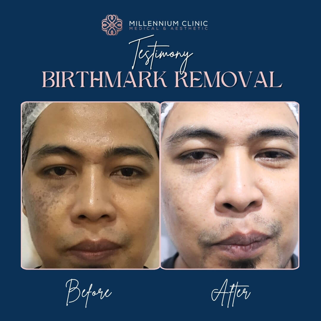 Birthmark_Removal__before_after_2