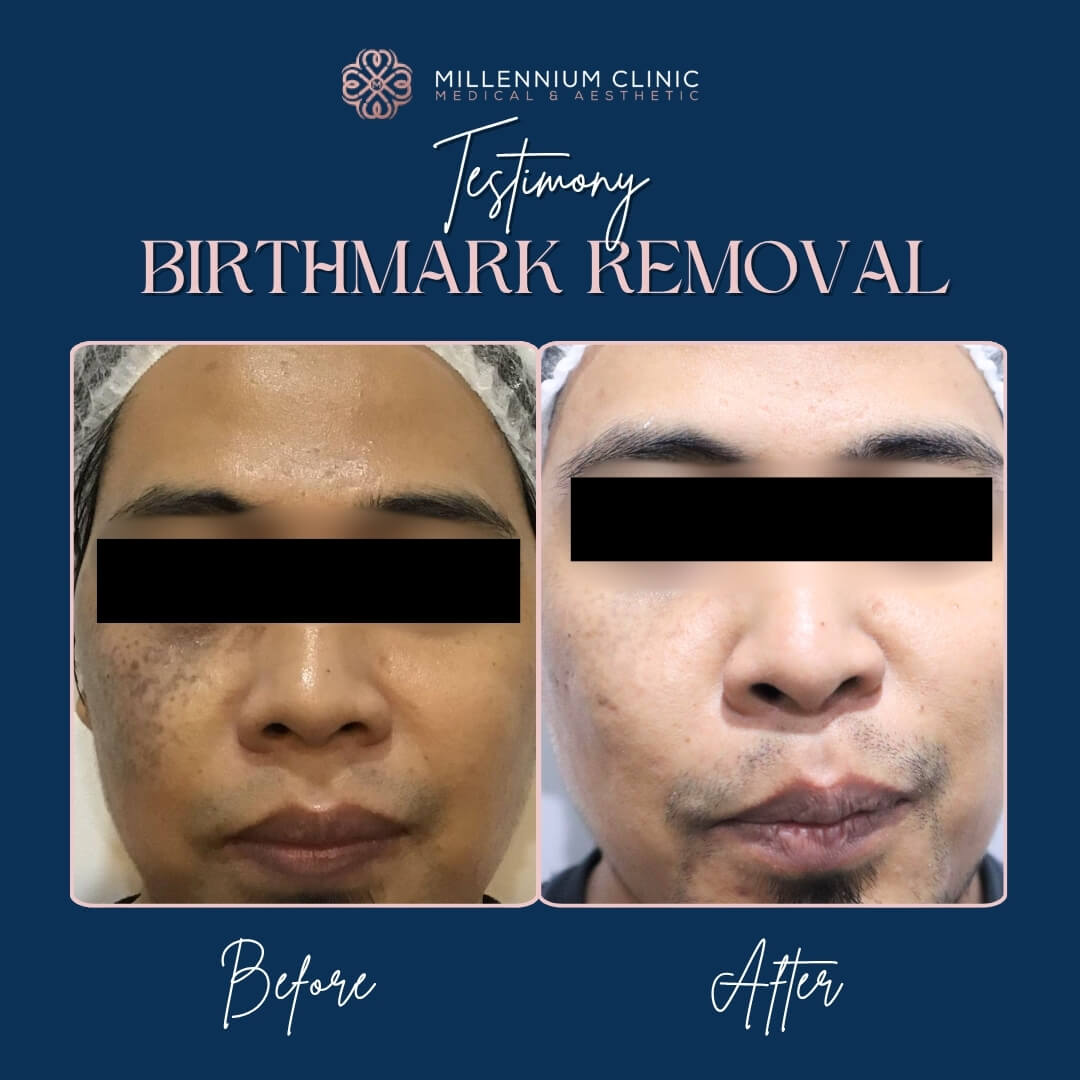 birth removal before after 1