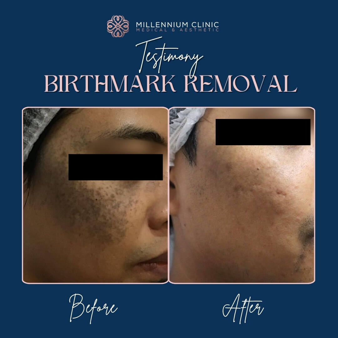 birth removal before after 2