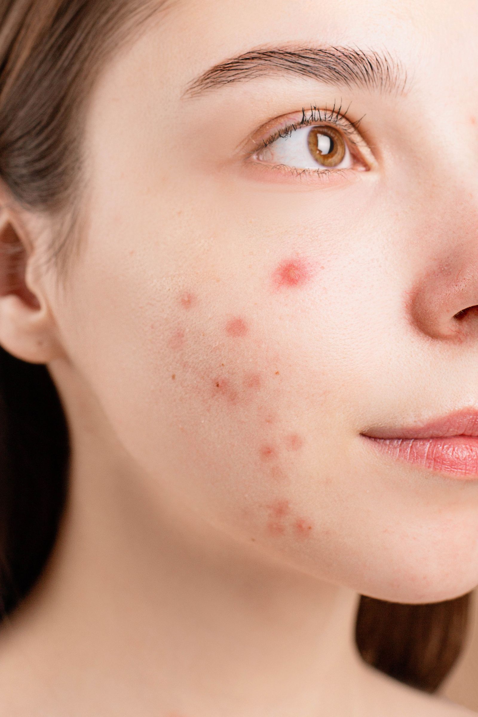 Close-up showing natural facial texture and pitted acne-scar concerns
