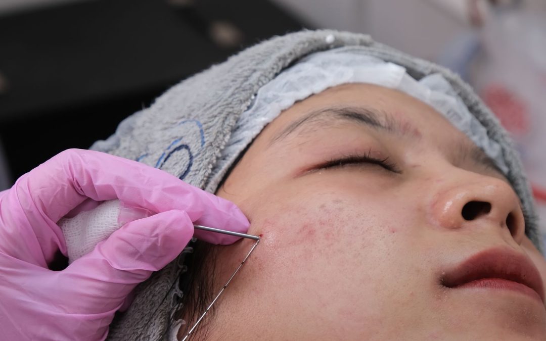 Close-up of a microneedling procedure performed in a clinical setting
